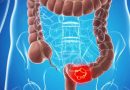 Brasil tem 45 mil diagnósticos de câncer no intestino por ano